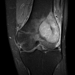 GCT Distal Femur MRI0001